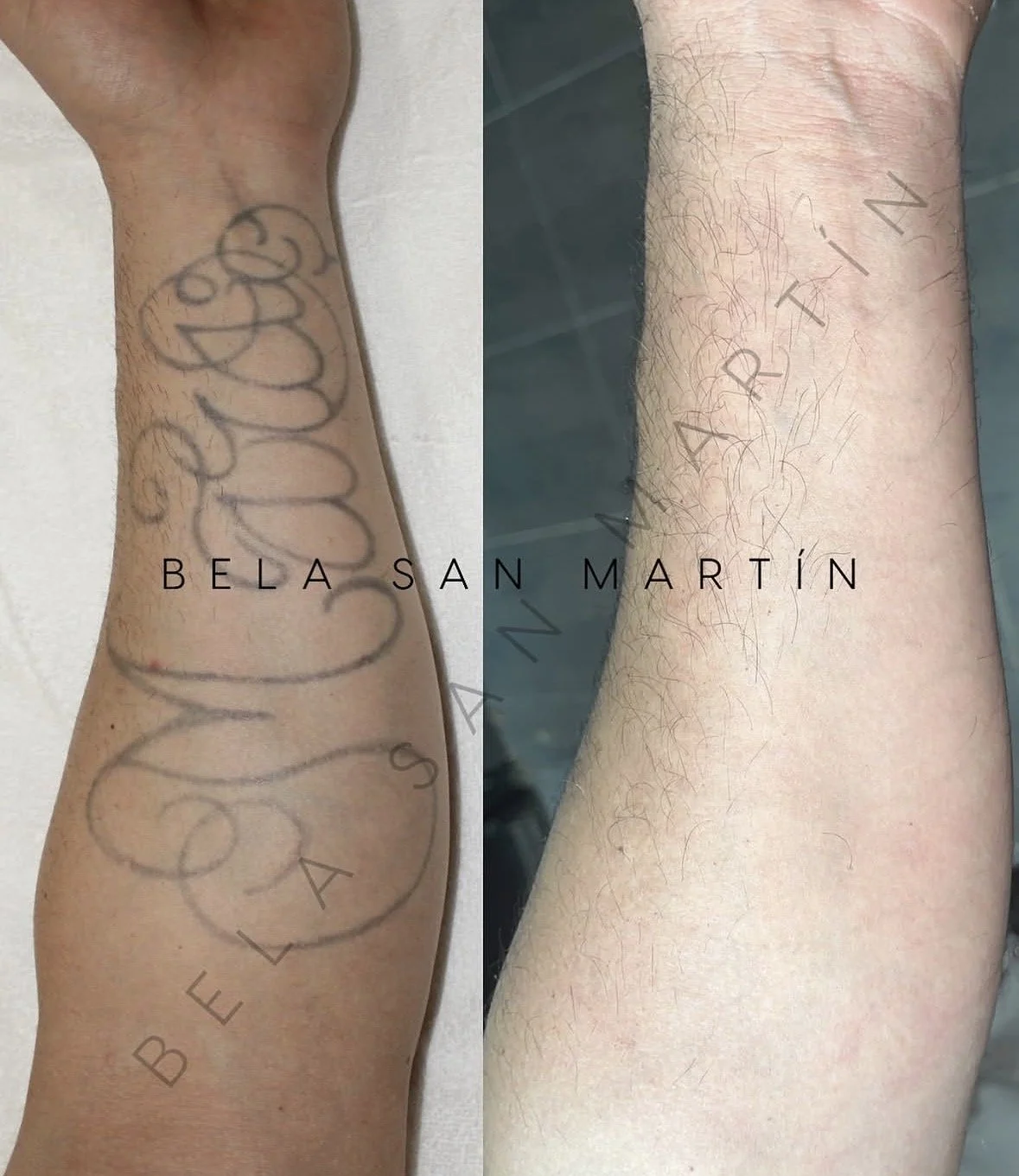 Antes y después de la eliminación láser tatuaje nombre brazo