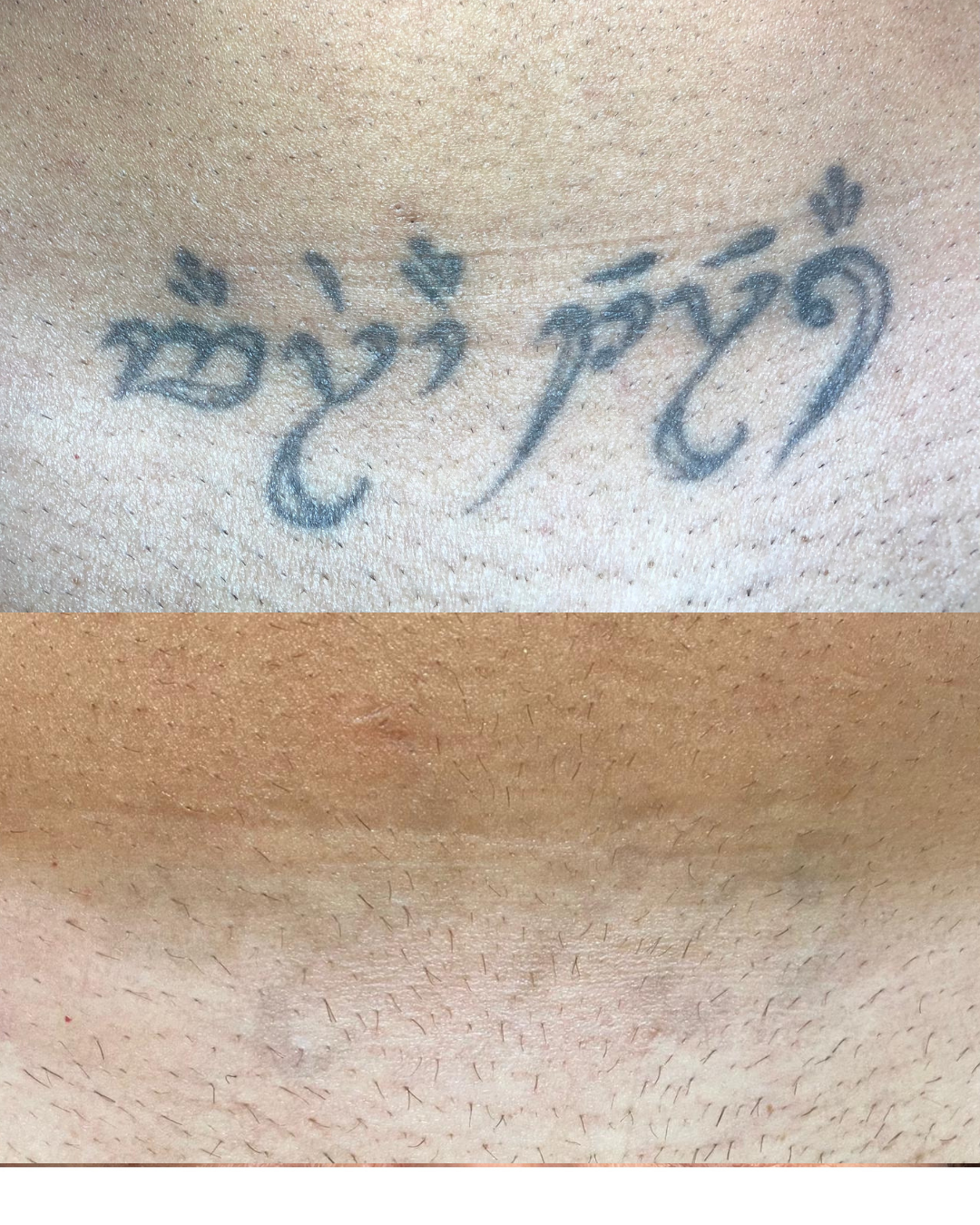 Antes y después de la eliminación láser de un tatuaje en el pubis