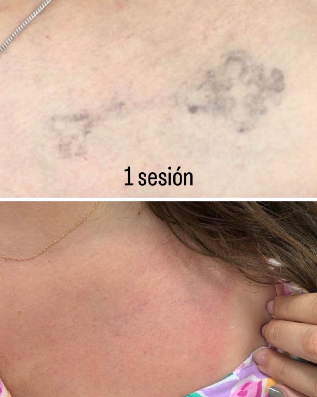 Antes y después de la eliminación láser de un tatuaje de llave