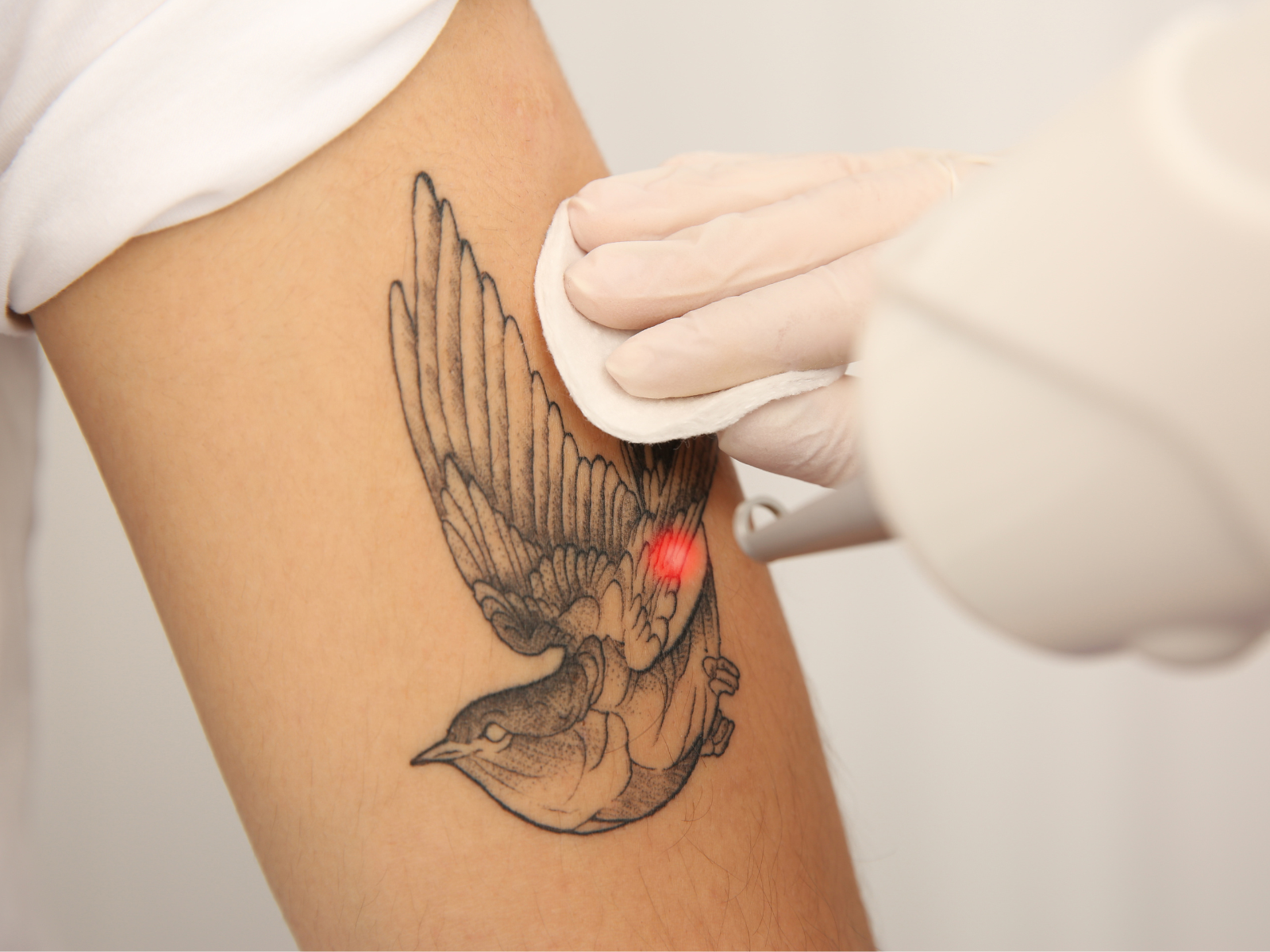 servicio eliminación láser en purezas tattoo gandía