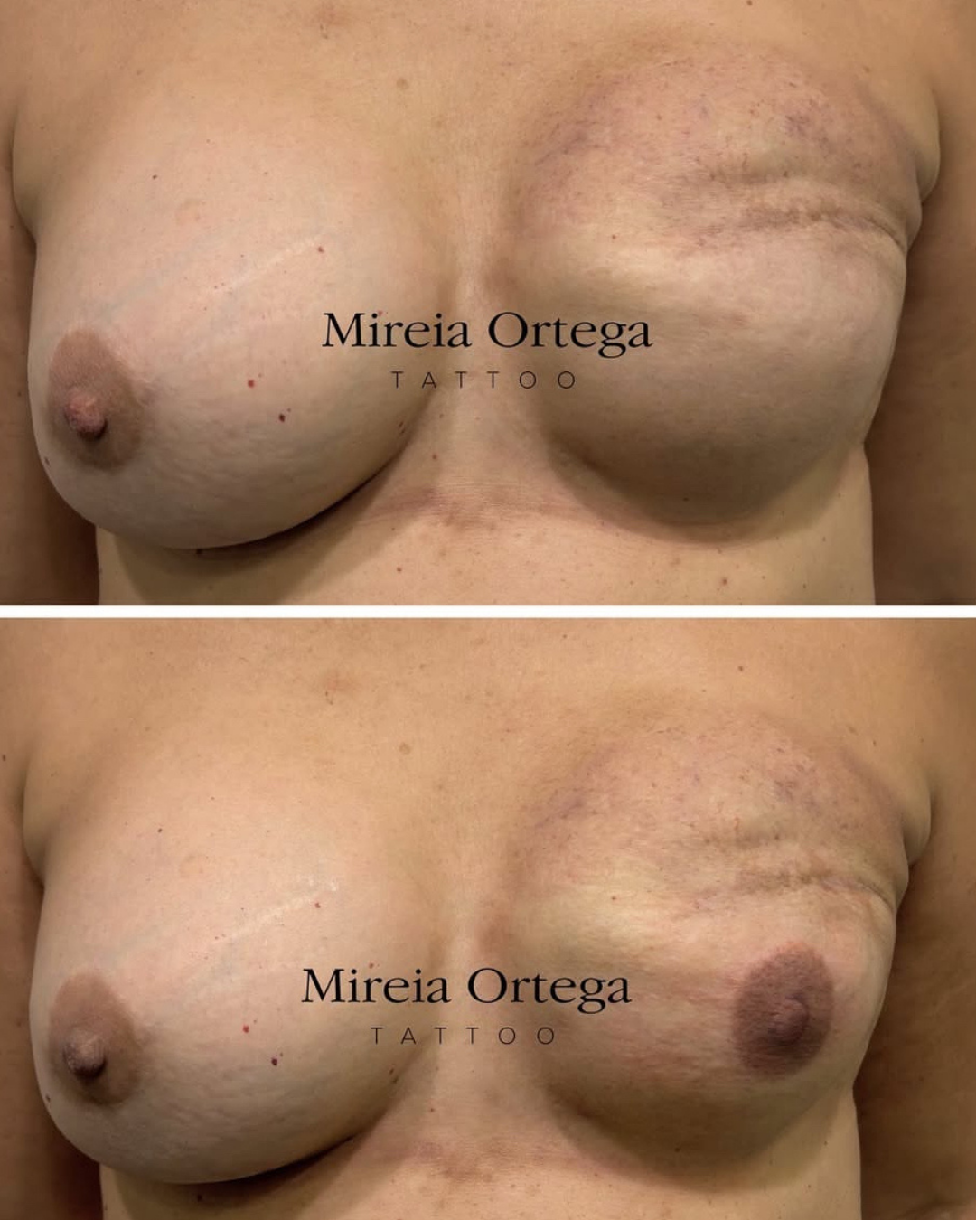 Antes y después de una reconstrucción de areola mediante tatuaje