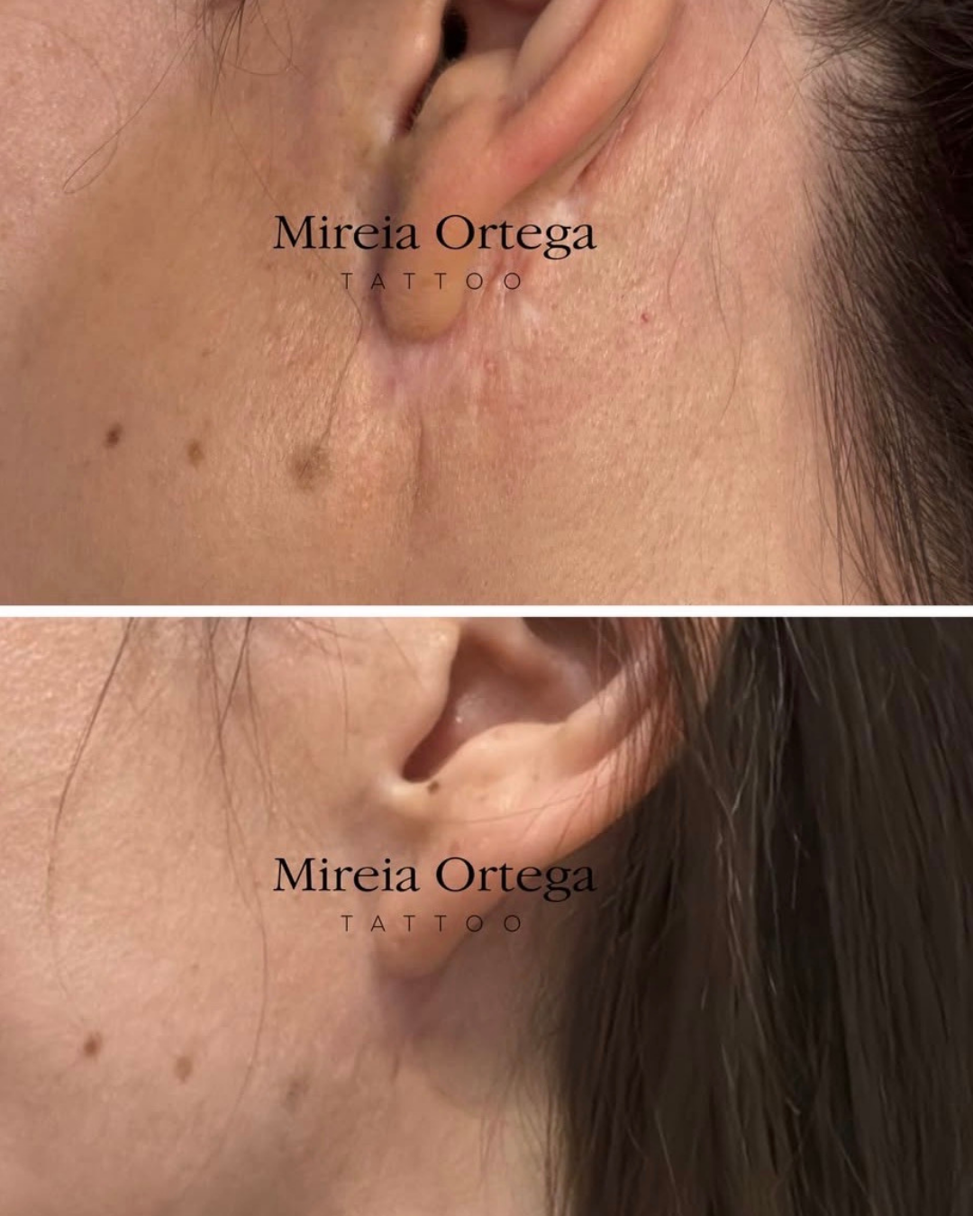 Antes y después de camuflaje de cicatriz con tatuaje estético