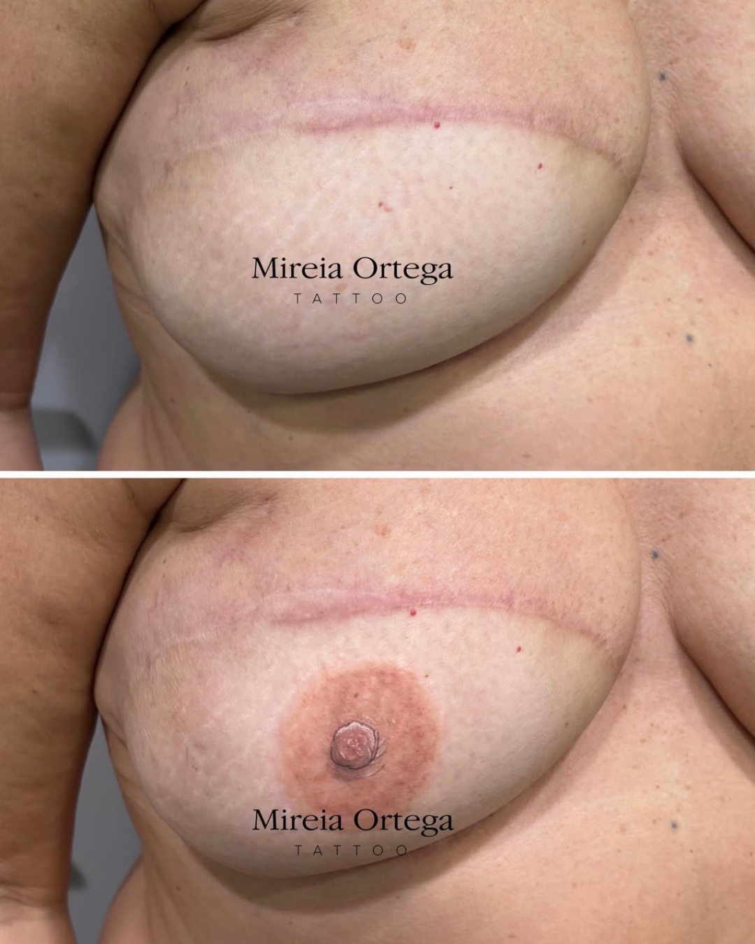 Reconstrucción unilateral de areola mediante tatuaje hiperrealista