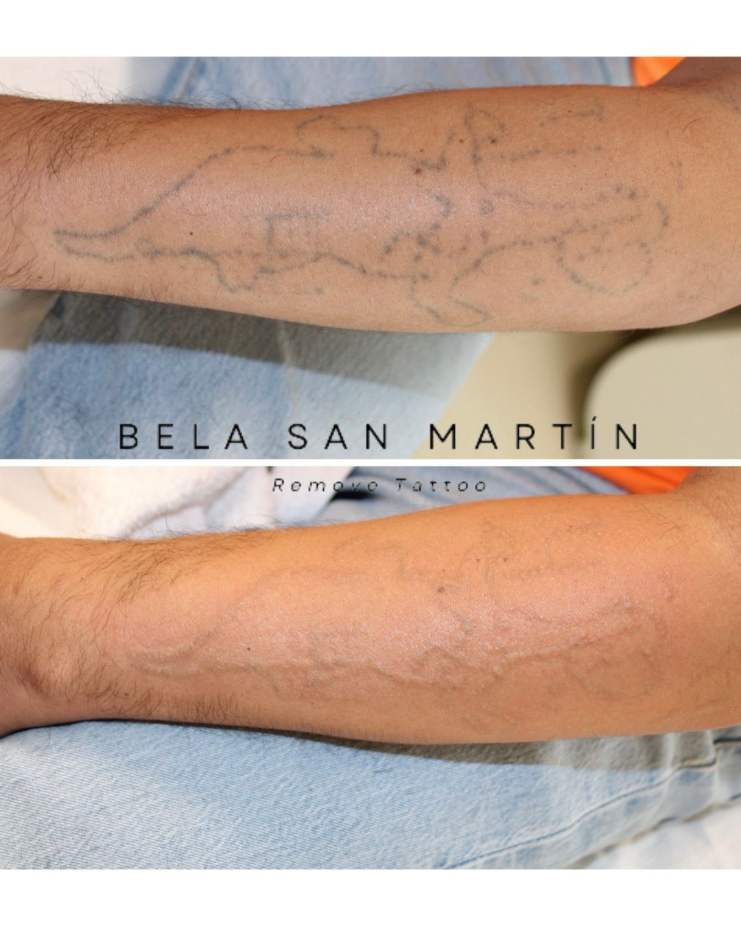 Antes y después de la eliminación láser de un tatuaje en el brazo