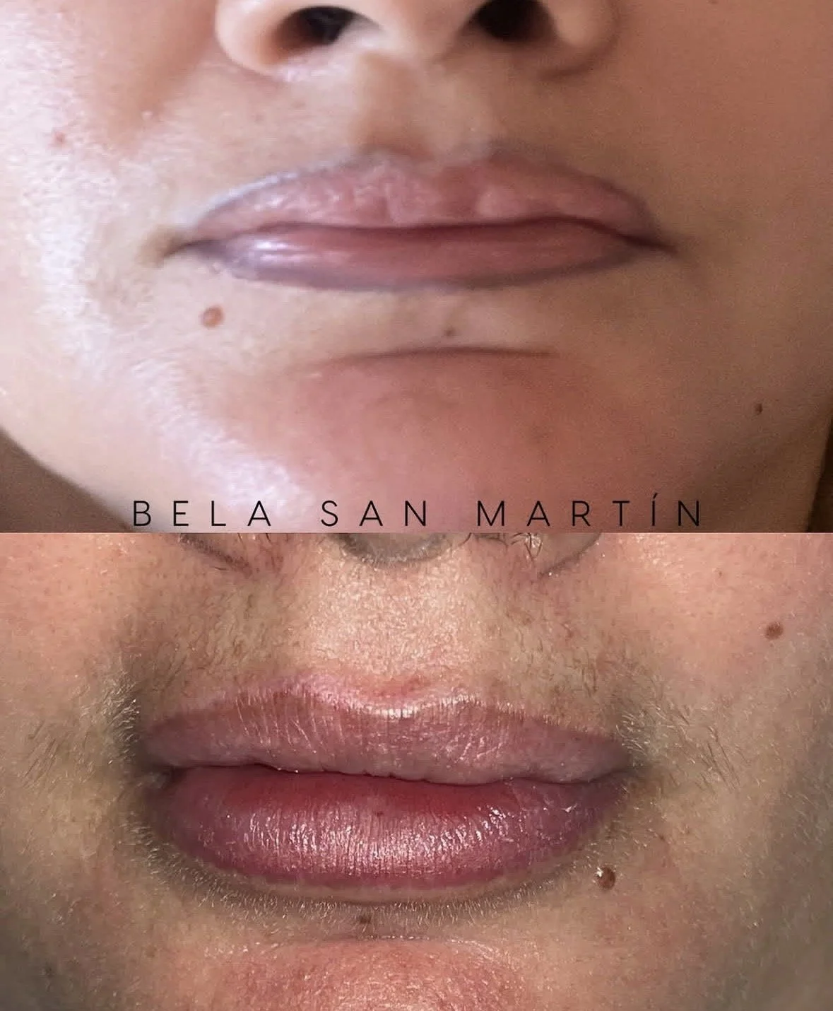 eliminación láser micropigmentación perfilador labios en purezas tattoo gandía