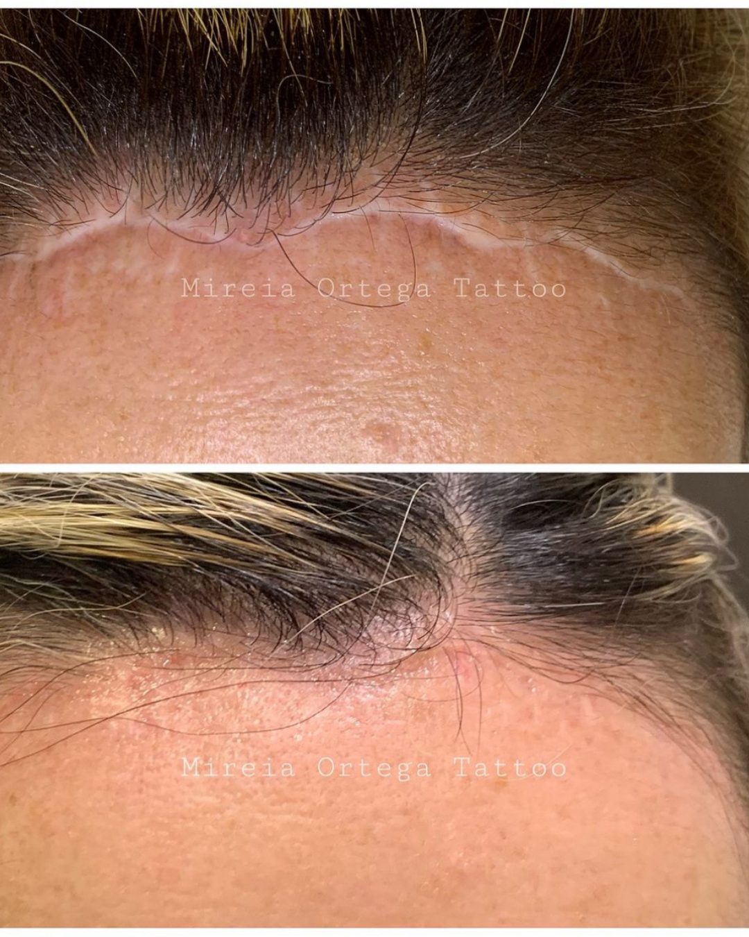 Antes y después de camuflaje de cicatriz con tatuaje estético en Purezas Tattoo Gandía