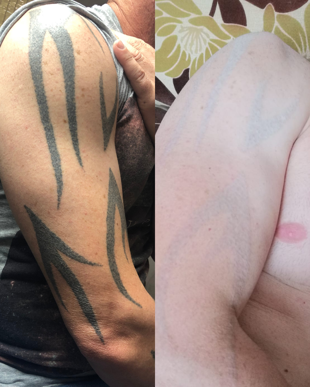 Antes y después de la eliminación láser tatuaje tribal brazo