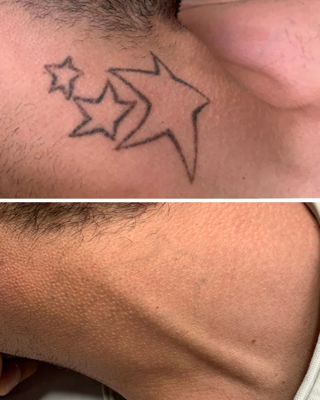 Antes y después de la eliminación láser de un tatuaje de estrellas