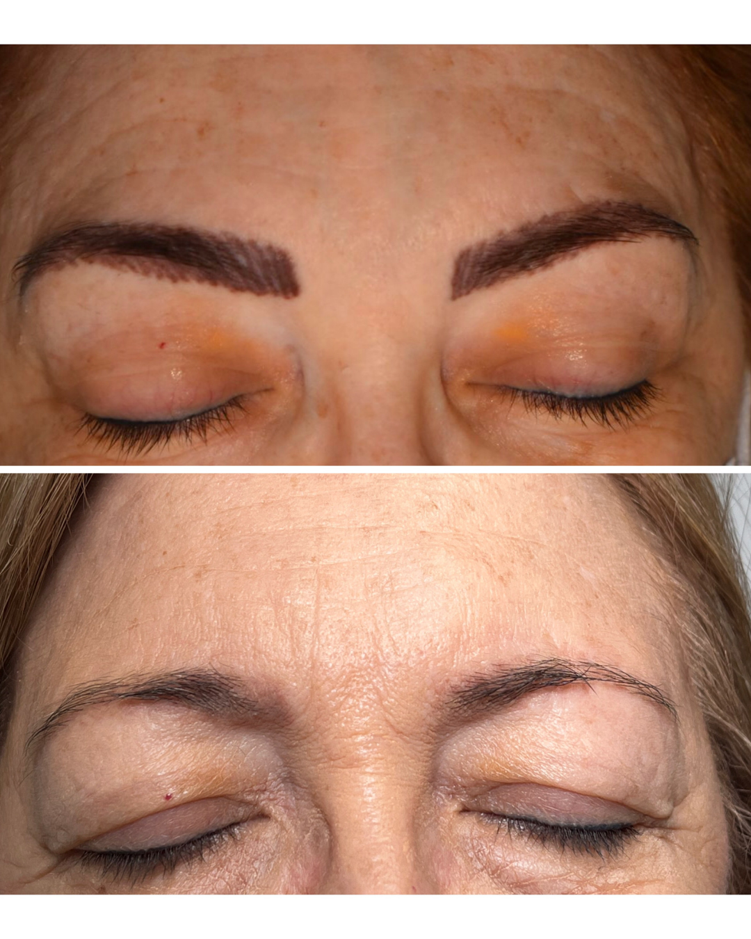 eliminación láser micropigmentación cejas en purezas tattoo gandía