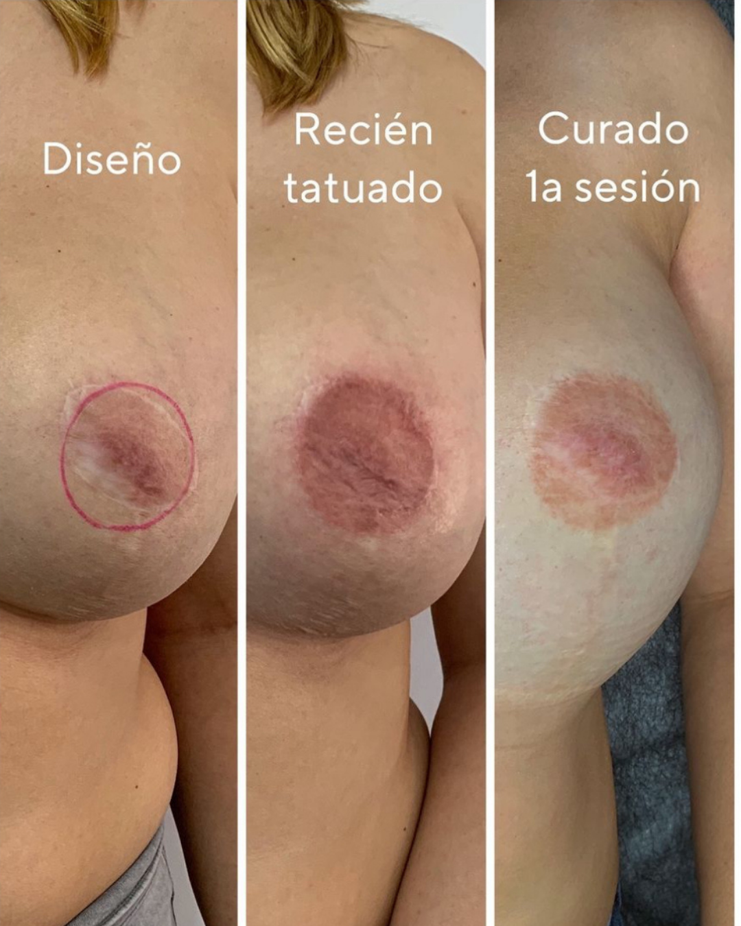 Detalle de reconstrucción de pezón y areola con efecto 3D