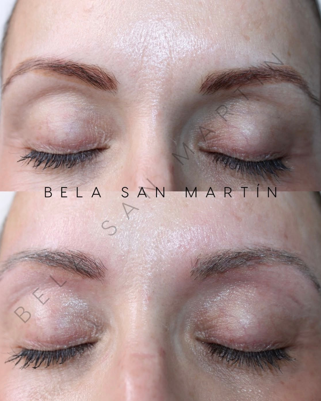 Antes y después de la eliminación láser de micropigmentación cejas1