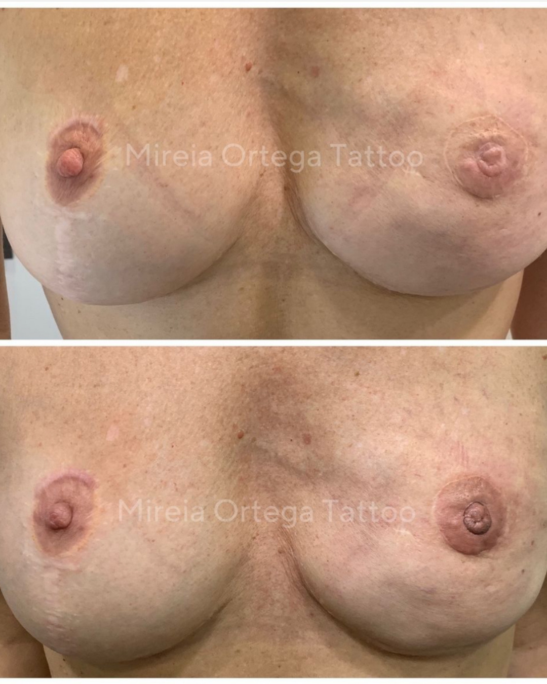 Reconstrucción de areola después de una cirugía mamaria