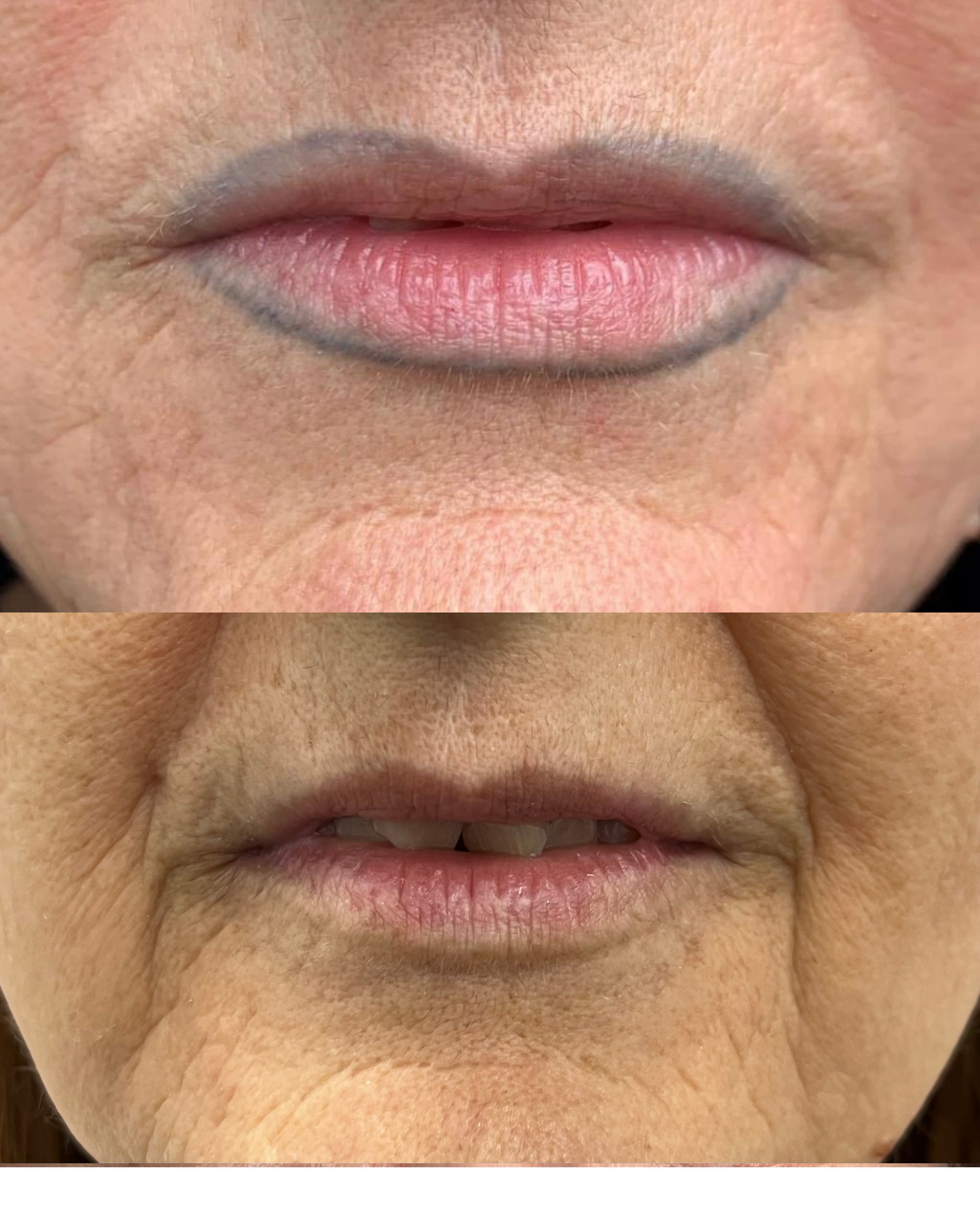 Antes y después de la eliminación láser de micropigmentación labios