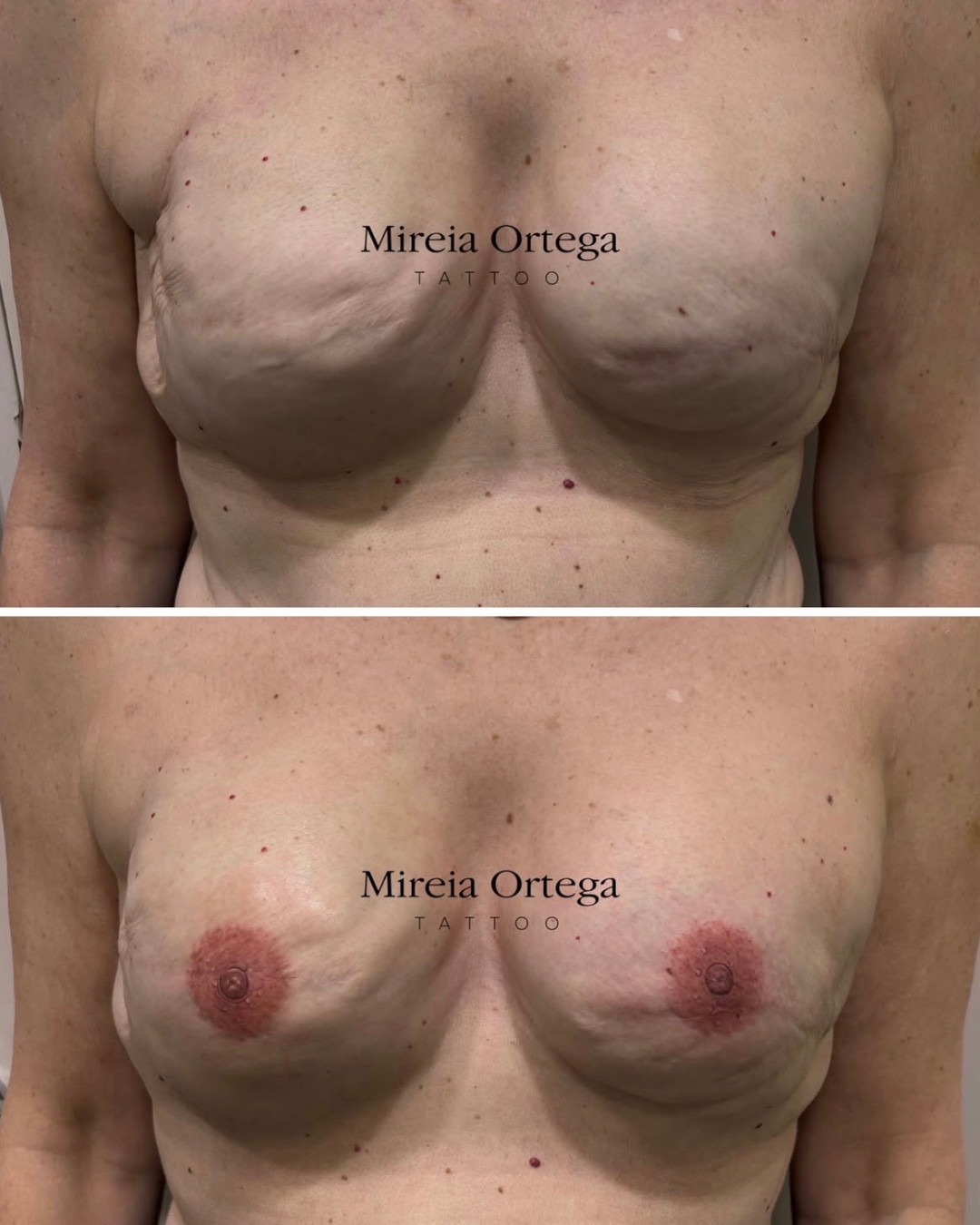 Reconstrucción bilateral de areolas mediante tatuaje