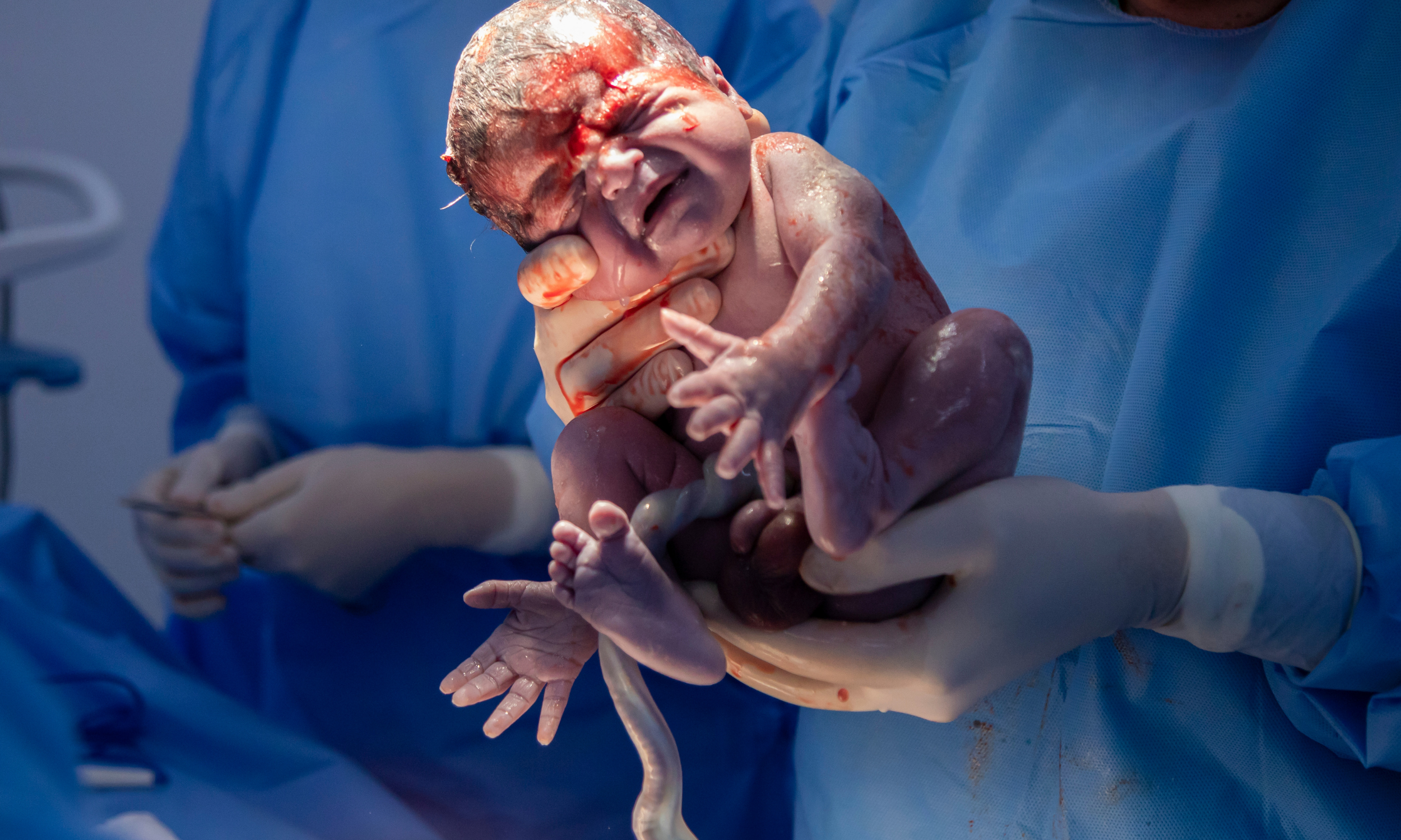 A newborn baby, still covered in blood and amniotic fluid, is being held by medical personnel in a surgical setting during a c-section.