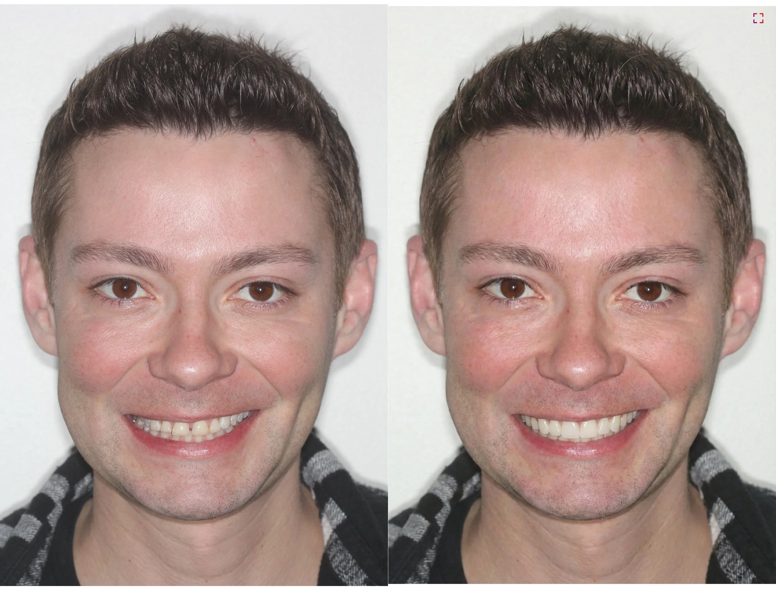 3DVNR™ process - Smilefy AI smile design