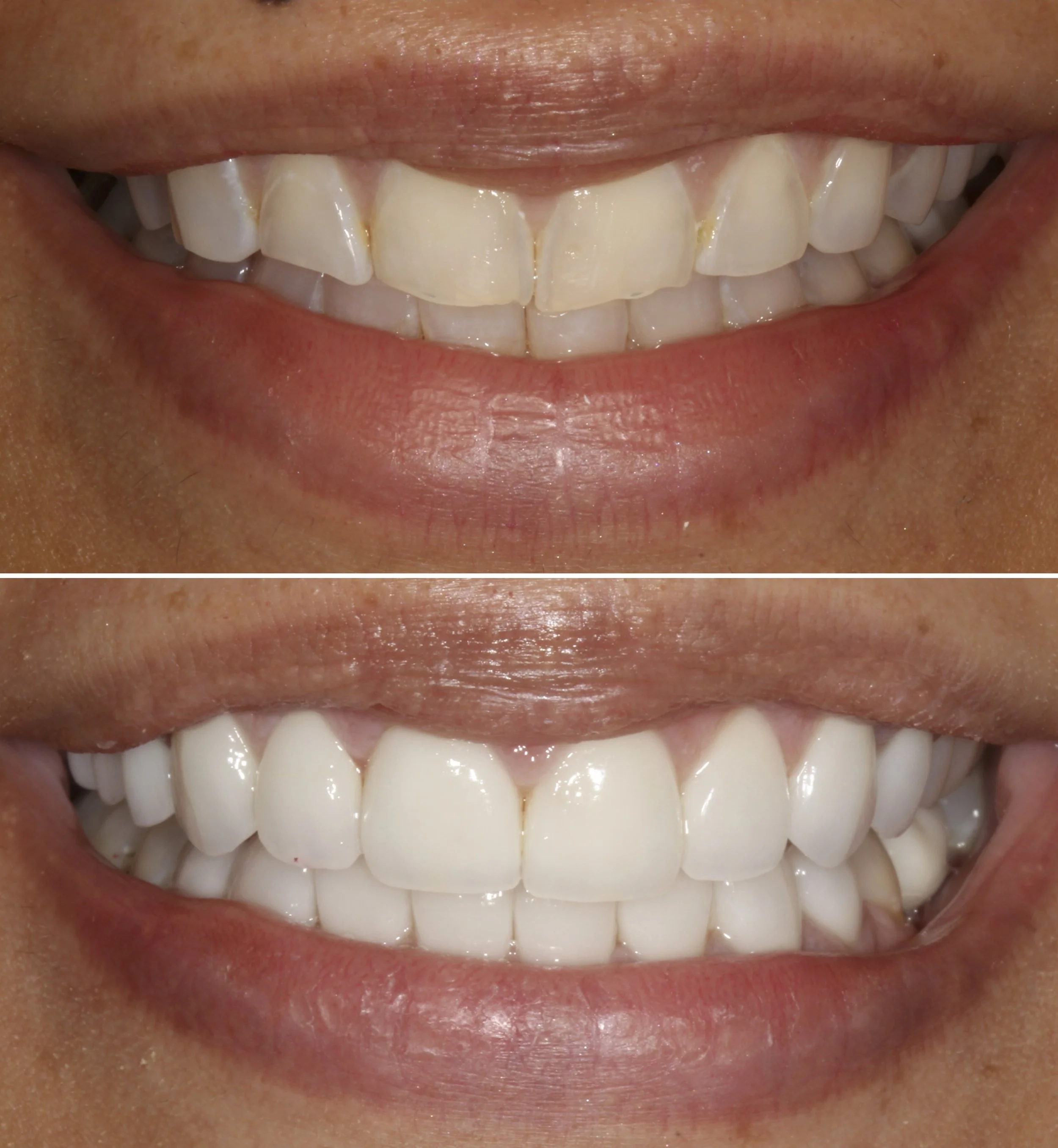 3DVNR™ case 03 - tooth wear