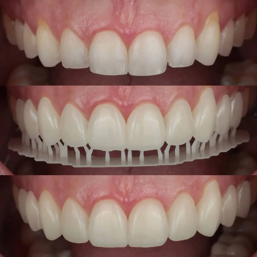 3DVNR™ process - REVEAL™ 3D printed prototype "trial smile" being placed on patients teeth.