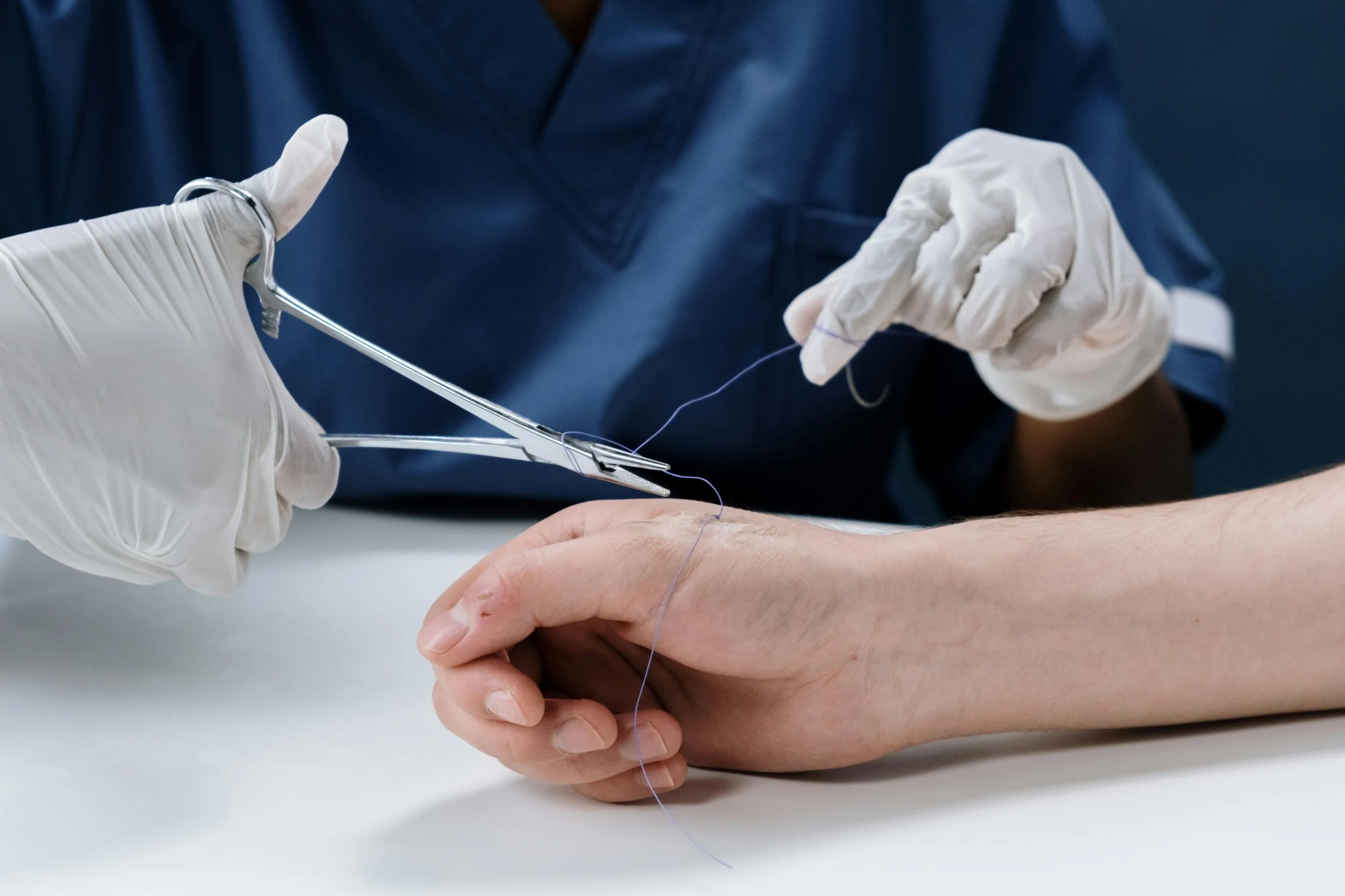 A healthcare professional wearing gloves is threading a needle with purple thread into a patient's hand during a medical procedure.