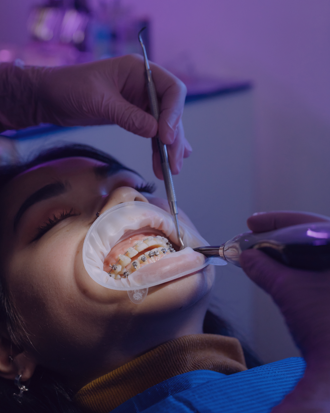 Teeth Whitening