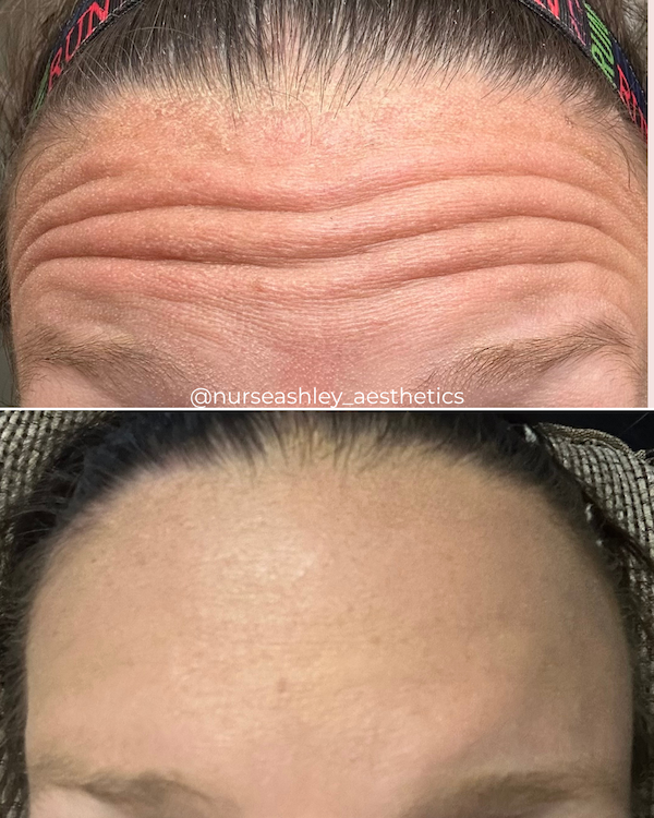 botox before and afters - 1.png
