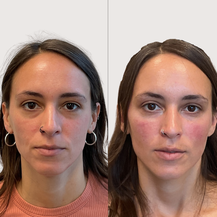 Midface Rejuvenation