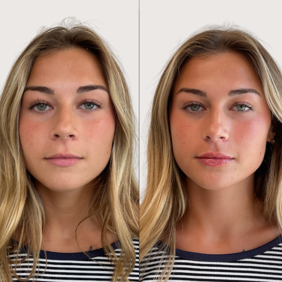 Lip Filler