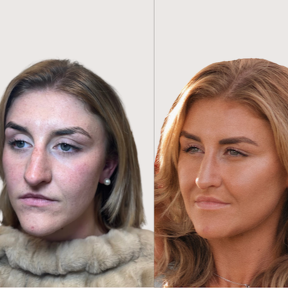 Midface+Rejuvenation.png