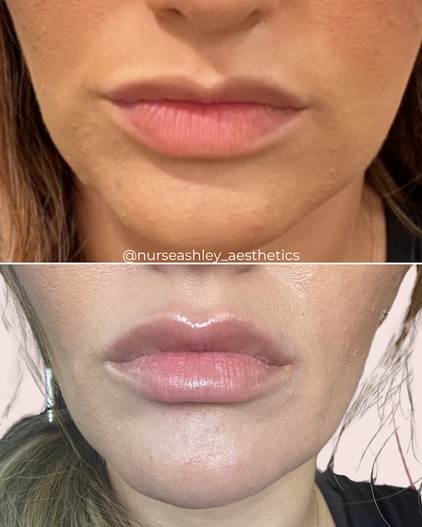 Lip Flip