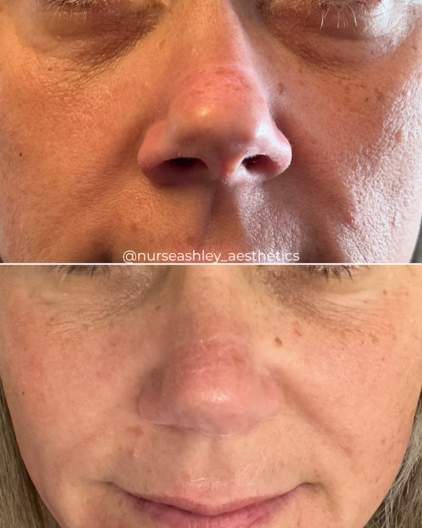 botox before and afters - 13.png