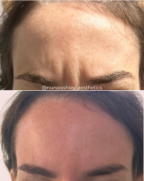 botox before and afters - 10.png