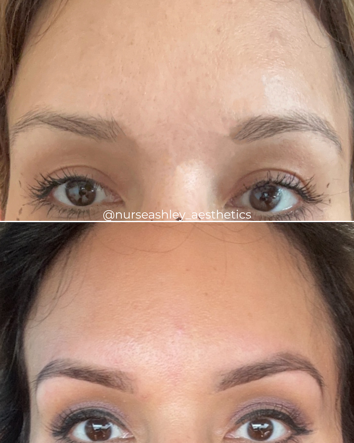 Brow Lift
