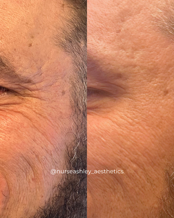 botox before and afters - 4.png