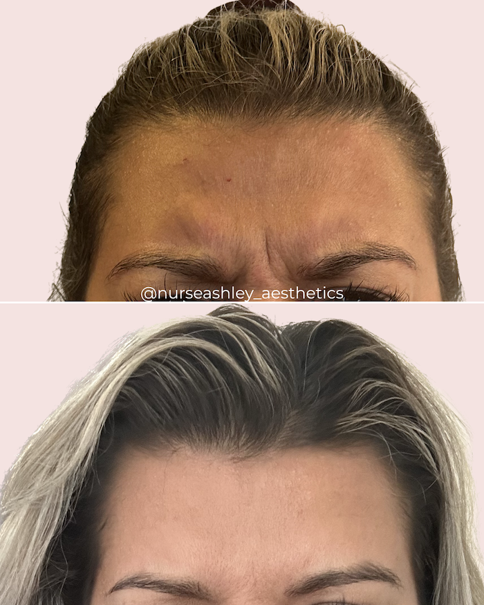 botox before and afters - 7.png