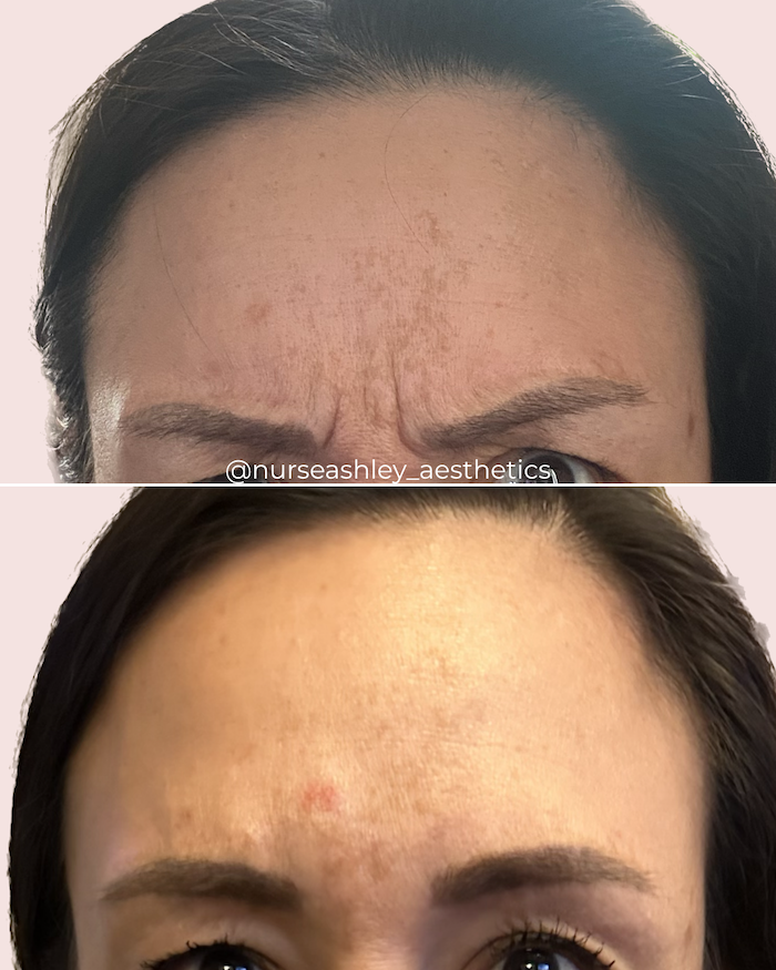 botox before and afters - 8.png