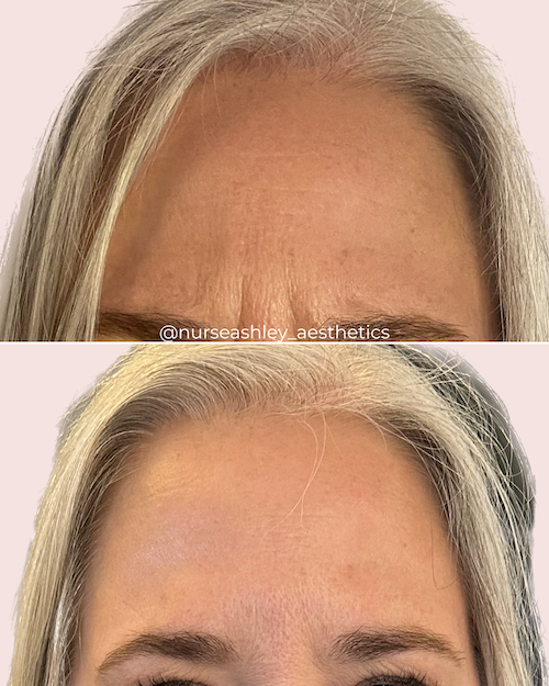 botox before and afters - 3.png