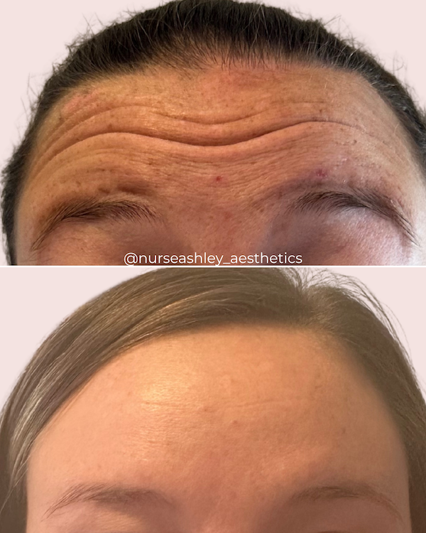 botox before and afters - 2.png