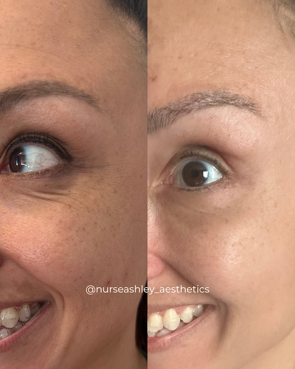 botox before and afters - 11.png