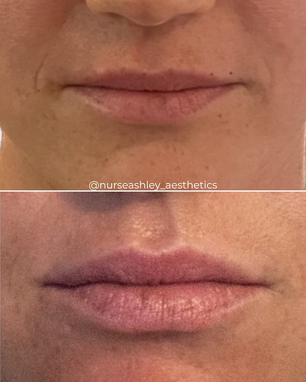 botox before and afters - 9.png