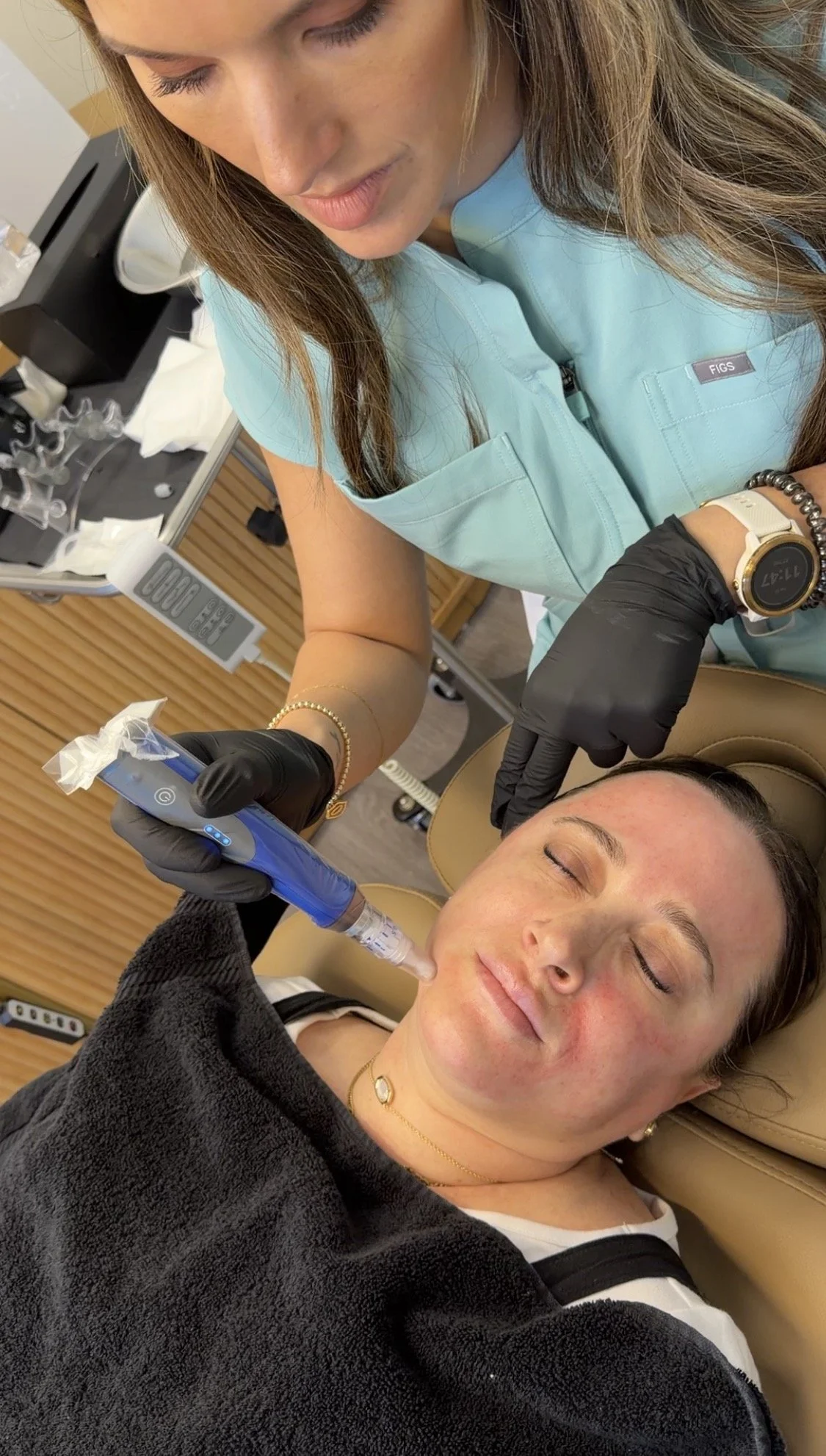 Microneedling