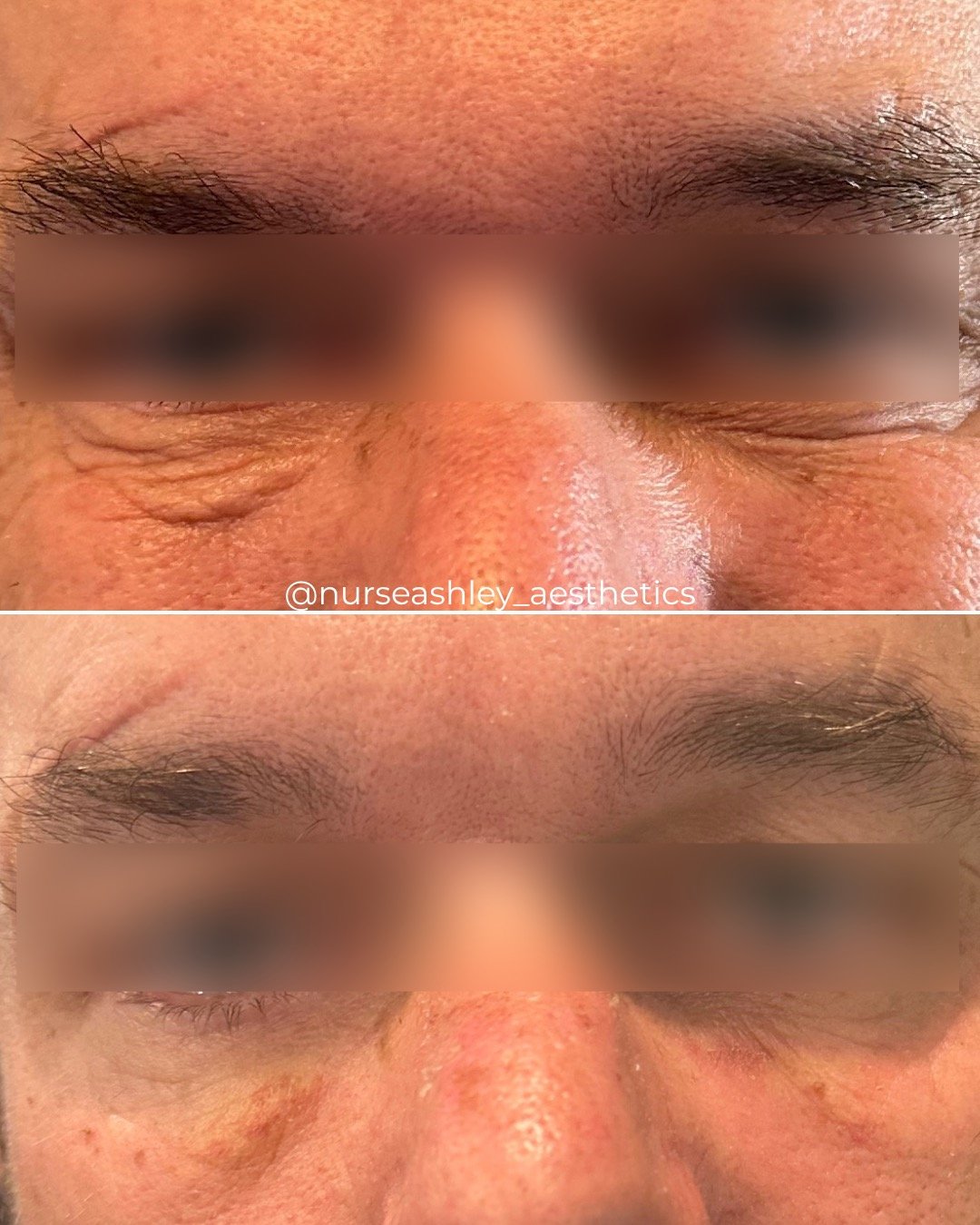 Undereye Microneedling