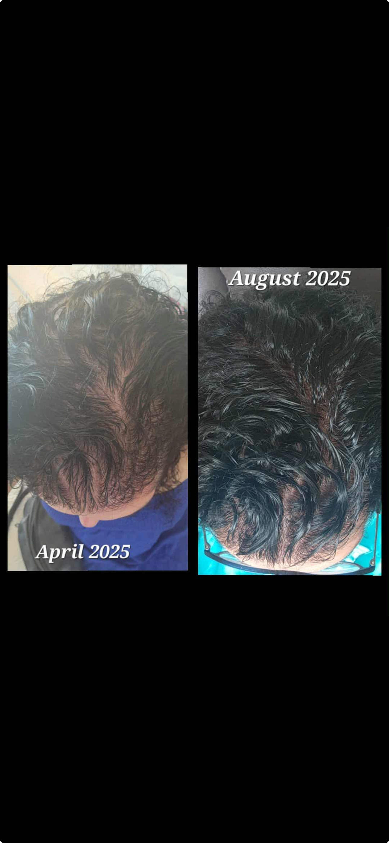 Comparison of a person's hair and scalp before and after hair growth, showing a fuller head of hair with less scalp visibility in August 2025 compared to April 2025.