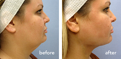 Side-by-side comparison of a woman's face showing improvement in skin condition and facial profile, labeled 'before' and 'after'.