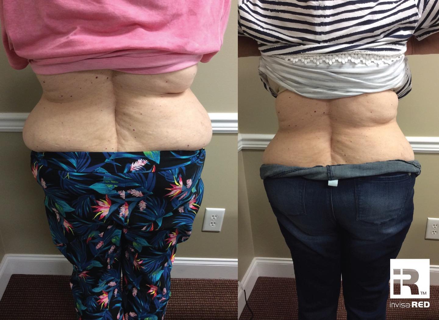 Side-by-side before and after photos of a woman’s back showing weight loss, with visible reduction in back fat and loose skin, wearing different clothes in each photo.