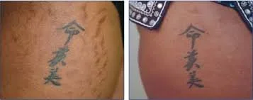 Comparison of a tattoo before and after removal, showing Chinese characters on skin.