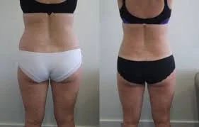Comparison of a woman's lower back and thighs before and after weight loss