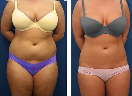 Comparison of a woman's midsection before and after weight loss or body transformation, showing a reduction in abdominal fat and a slimmer waistline