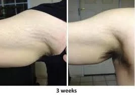 Comparison of underarm skin showing three weeks of improvement, with reduced darkness and smoother appearance.