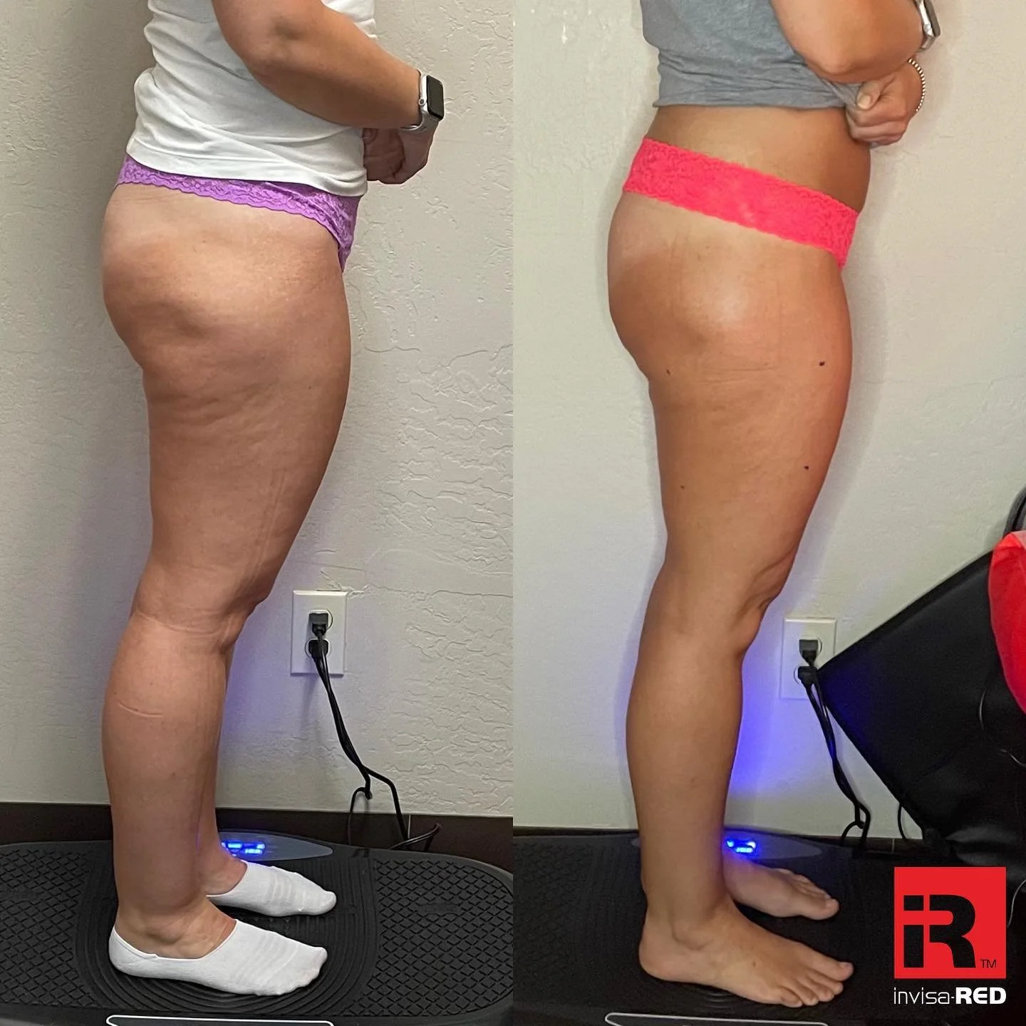 Side-by-side comparison of a woman before and after a body transformation showing reduced appearance of cellulite on her thighs and buttocks. She is standing on a black vibration plate in both images, wearing a white shirt and purple underwear in the