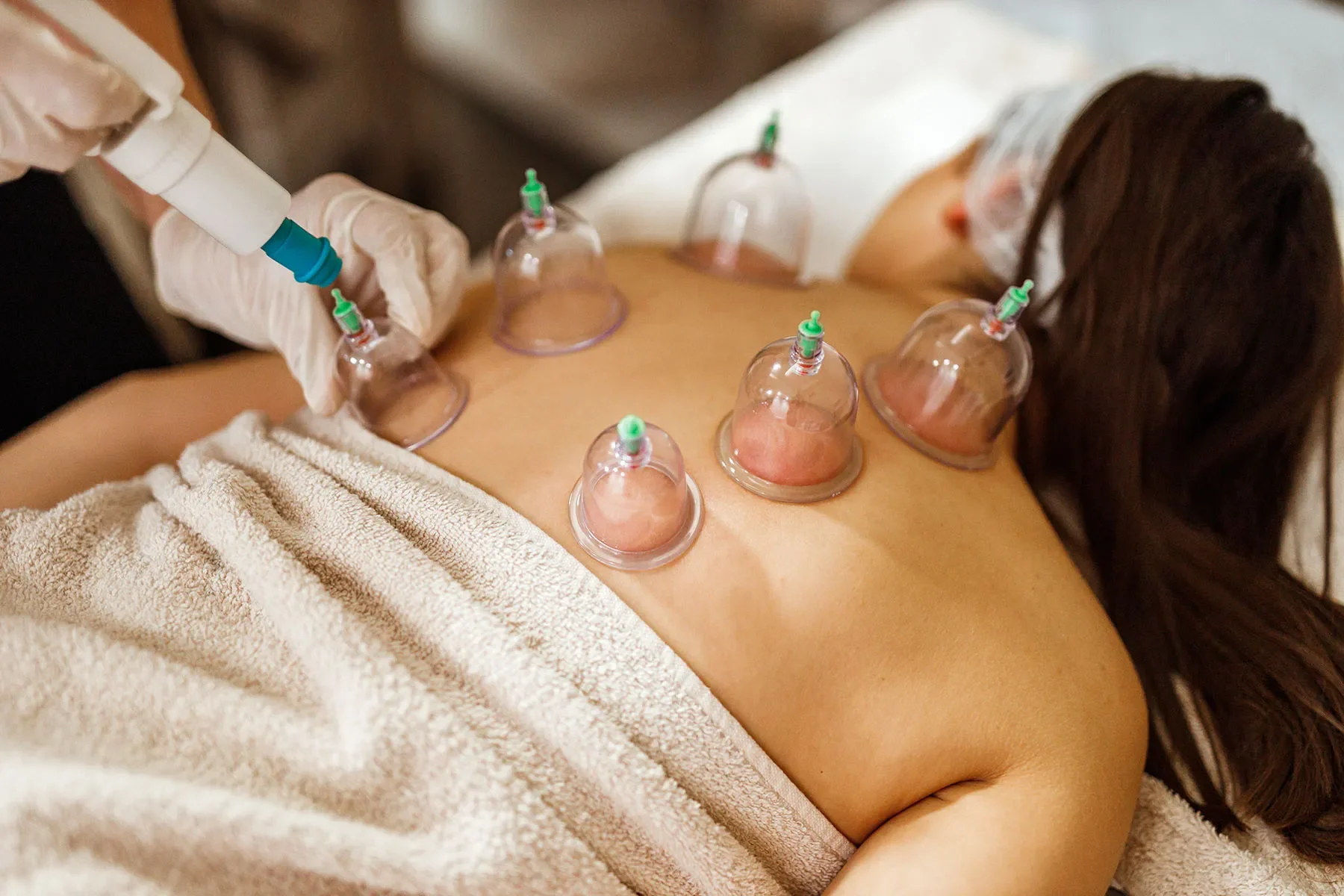 A person receiving cupping therapy on their back, with several glass cups creating suction. A practitioner wearing gloves is adjusting one of the cups. The person is lying face down on a towel.